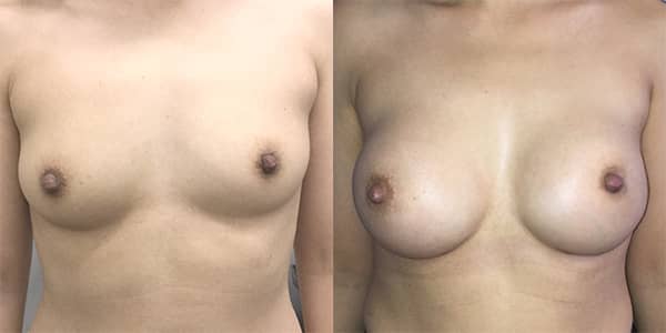 Breast Enlargement 111 Harley St.