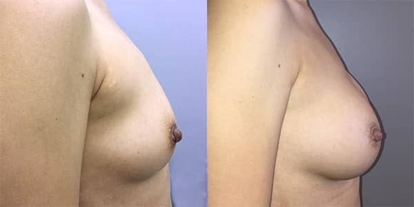 Breast Enlargement 111 Harley St.