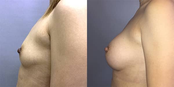 Breast Enlargement 111 Harley St.