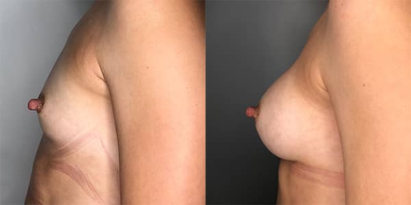 Breast Enlargement 111 Harley St.