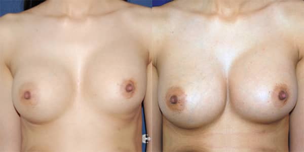 Breast Enlargement 111 Harley St.