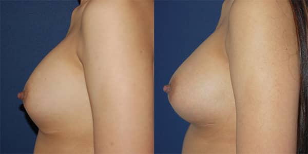 Breast Enlargement 111 Harley St.