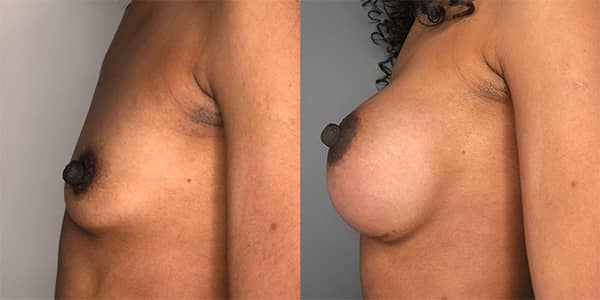 Breast Enlargement 111 Harley St.