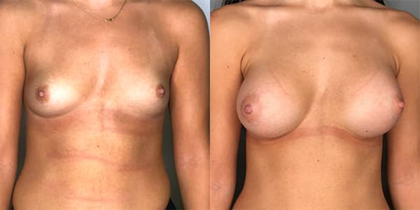 Breast Enlargement 111 Harley St.