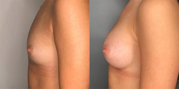 Breast Enlargement 111 Harley St.