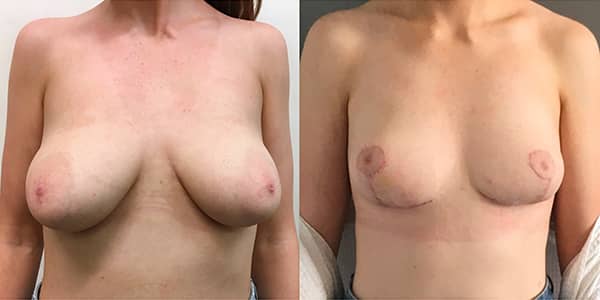Breast Lift London Plastic Surgery