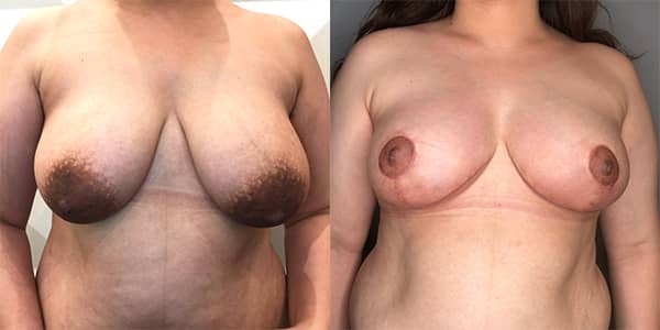 Breast Reduction 111 Harley St.