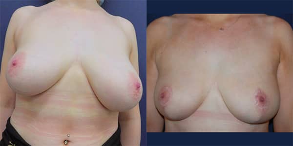 Breast Reduction 111 Harley St.