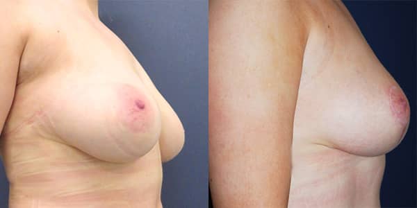 Breast Reduction 111 Harley St.