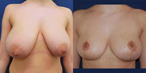 Breast Reduction 111 Harley St.