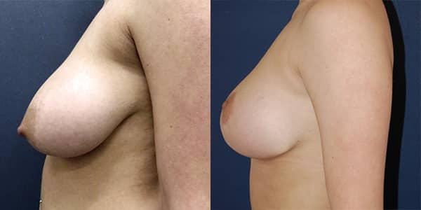 Breast Reduction 111 Harley St.