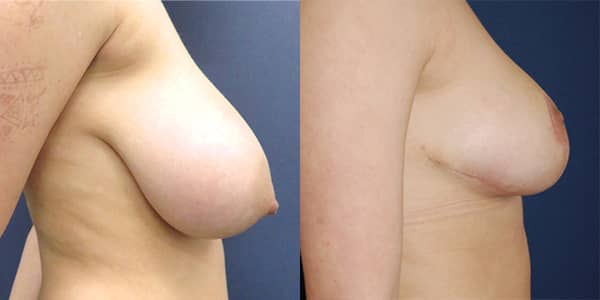 Breast Reduction 111 Harley St.