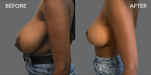 Breast Reduction London