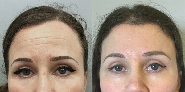 Brow Lift 111 Harley St.