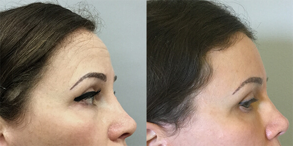 Brow Lift 111 Harley St.