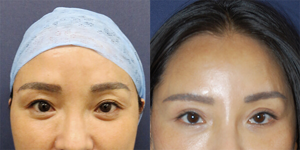 Brow Lift 111 Harley St.