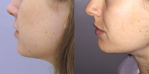 Buccal Fat Removal 111 Harley St.