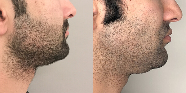 Buccal Fat Removal