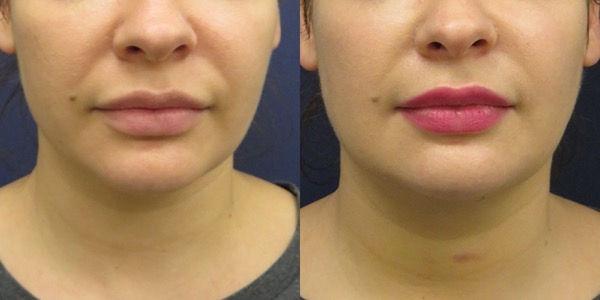 Buccal Fat Removal Before & After