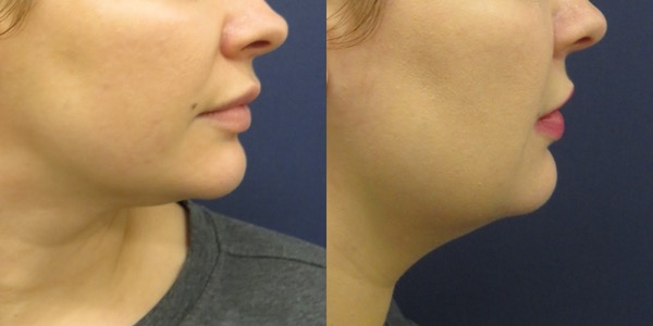 Buccal Fat Removal Before & After