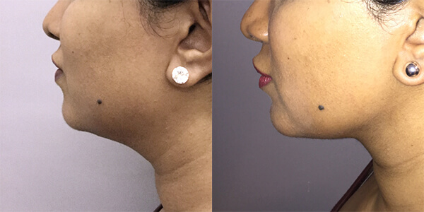 Buccal Fat Removal 111 Harley St.