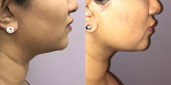 Buccal Fat Removal 111 Harley St.