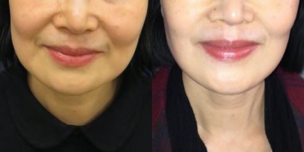 Buccal Fat Removal Before & After