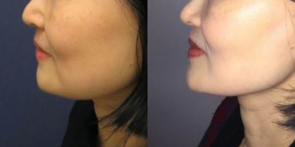 Buccal Fat Removal Before & After