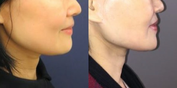 Buccal Fat Removal Before & After