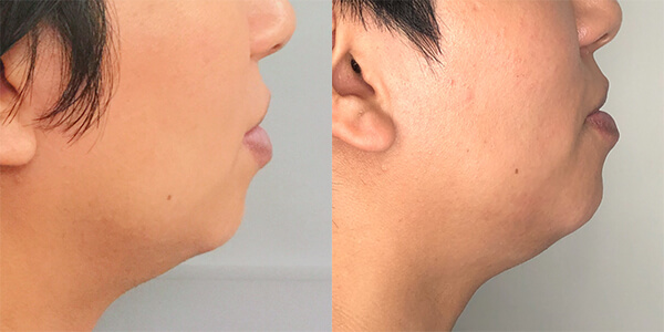 Buccal Fat Removal 111 Harley St.