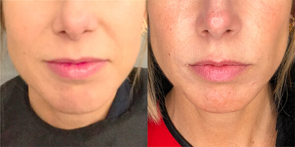 Buccal Fat Removal 111 Harley St.