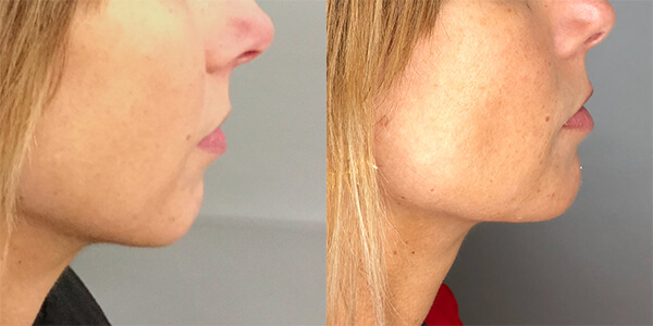 Buccal Fat Removal 111 Harley St.