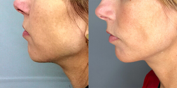 Buccal Fat Removal 111 Harley St.