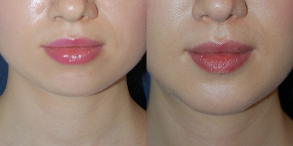 Chin Implant Before & After