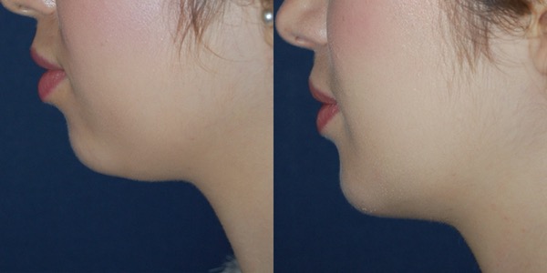 Chin Implant Before & After