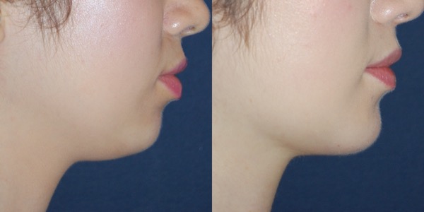 Chin Implant Before & After