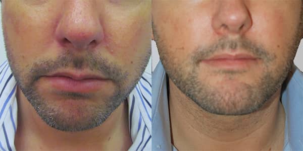 Chin Implant London 111 Harley St.