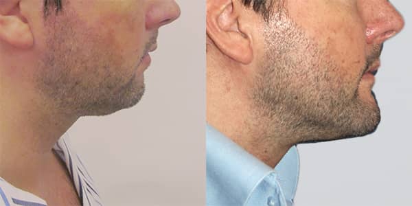 Chin Implant London 111 Harley St.