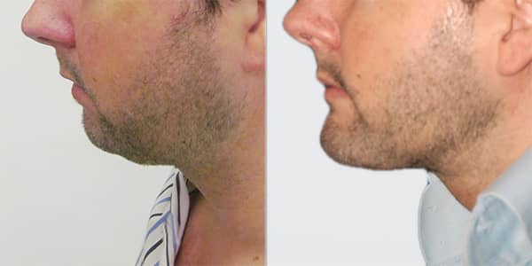 Chin Implant London 111 Harley St.