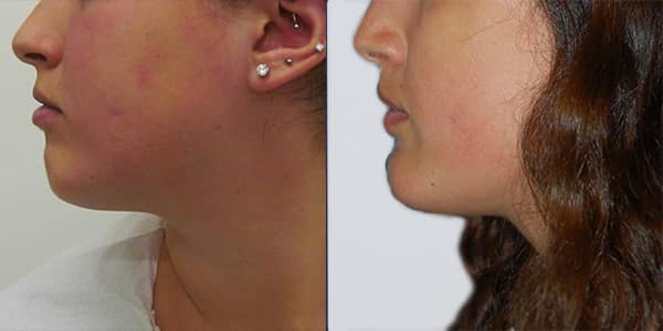 Chin Implant London 111 Harley St.