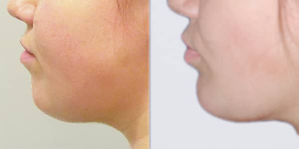 Chin Implant London 111 Harley St.