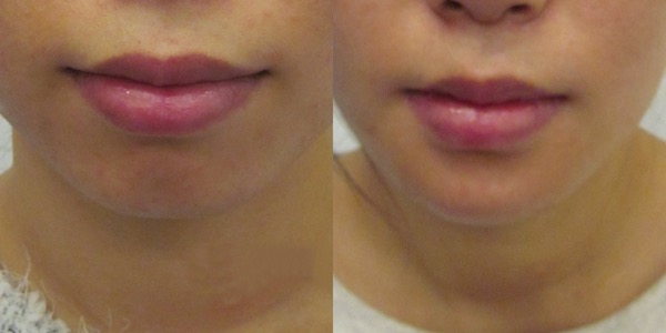 Chin Implant Before & After