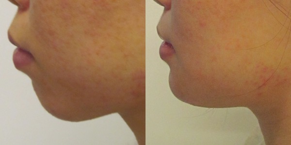 Chin Implant Before & After