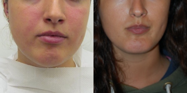 Chin Implant Before & After