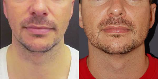 Chin Implant London 111 Harley St.