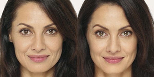 Dermal Filler Before & After