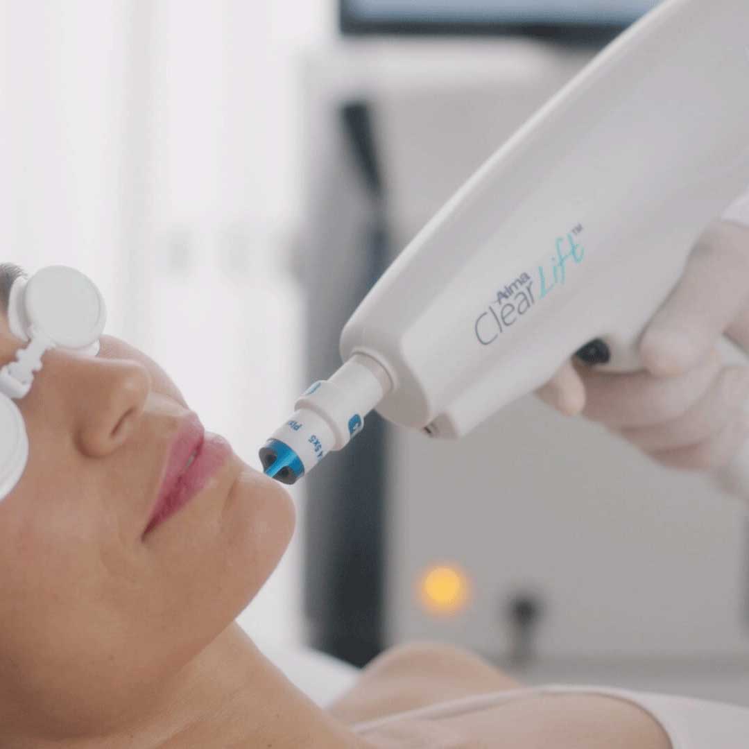 ClearLift laser treatment