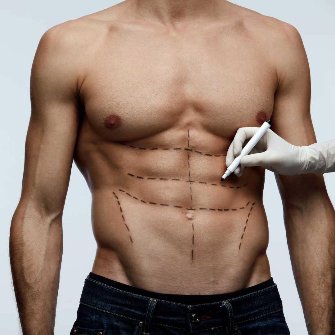 Ab Definition? Try VASER Liposuction