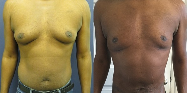 Gynaecomastia Before & After