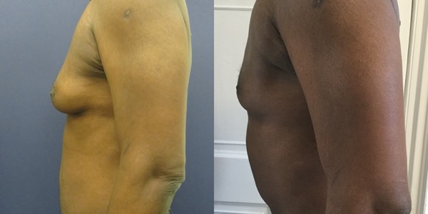 Gynaecomastia Before & After